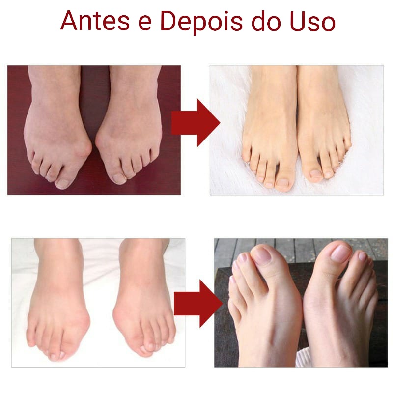 Protetor de Joanete Ortopédico em Silicone Gel